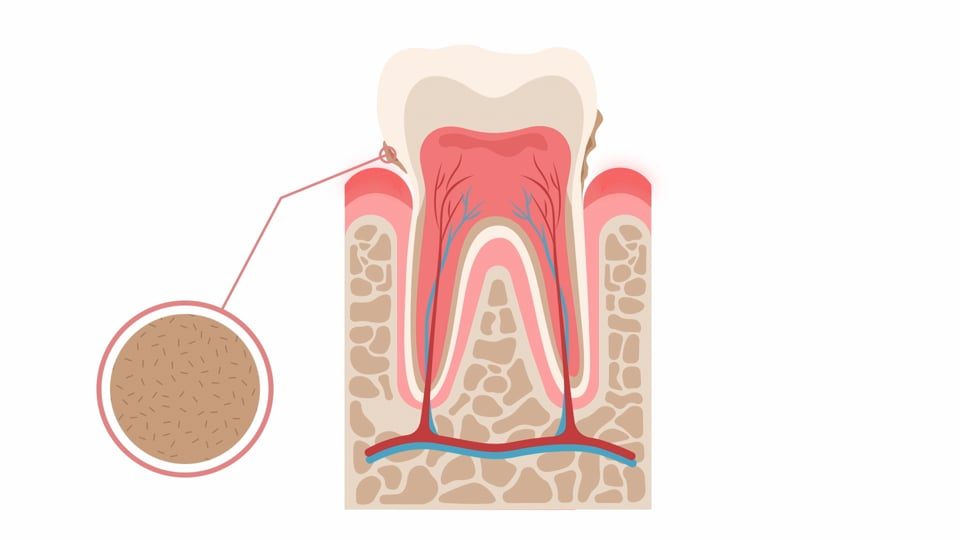 Dental Health and Periodontitis